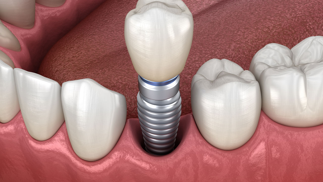 Do dental implants get cavities?